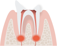 むし歯の進行C4