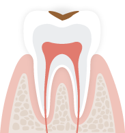 C1歯の表面エナメル質に留まっているむし歯